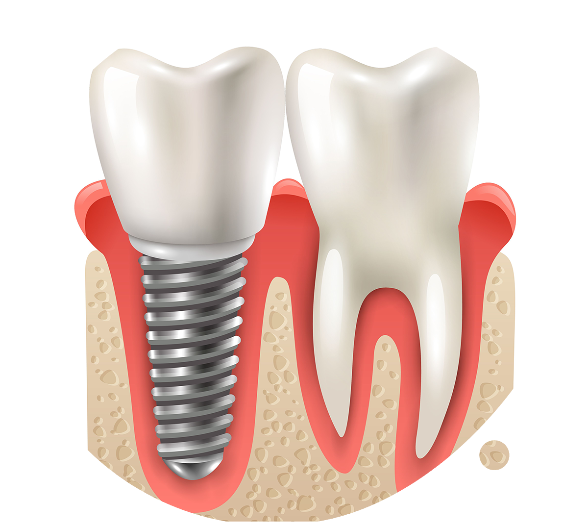 wp-content/uploads/sites/18/2020/01/implants.png
